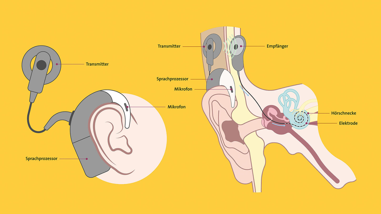 Chochleaimplantat Schematische Darstellung eines Cochlea-Implantates